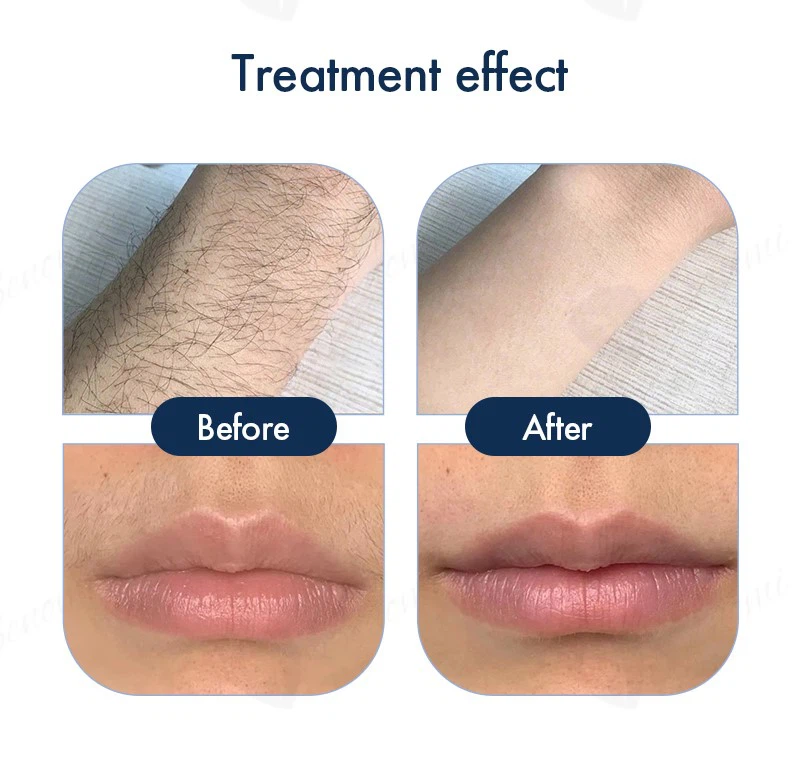 ND-YAGDiode-laser-D110 ND-YAGDiode-laser-D110