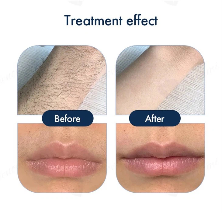 Special Edition Laser Hair Removal