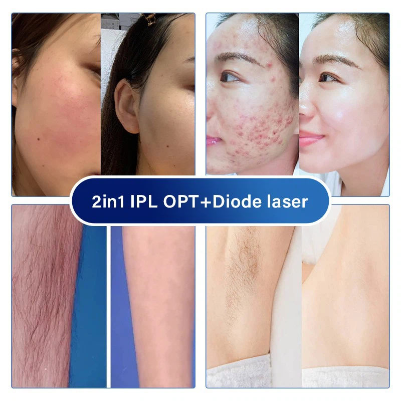 2 IN 1 MACHINE IPL OPT+DIODE LASER price